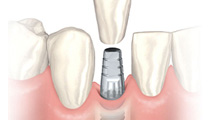 インプラント